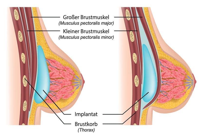 Platzierungsmöglichkeiten der Brustimplantate
